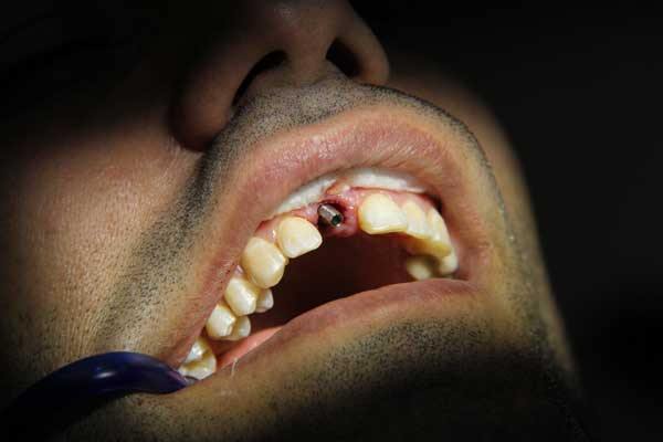 تفاوت ایمپلنت دندان با دندان طبیعی 