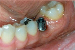 ایمپلنت دندان و بررسی اباتمنت ها 