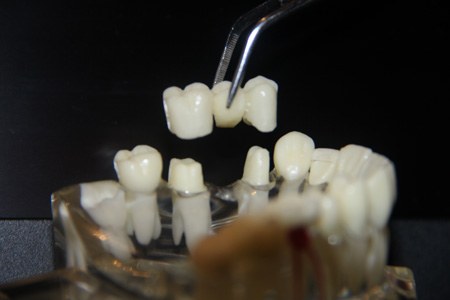 ایمپلنت مناسب برای پل های دندانی فرسوده 