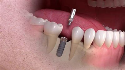 ایمپلنت دندان و فواید گسترده آن  