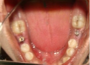ایمپلنت دندان و بررسی کاور اسکرو در آن 